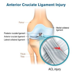 ACL Injury Treatment Dubai