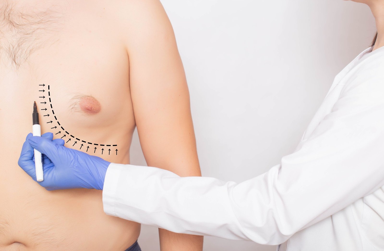 Gynecomastia Excision Surgery Package