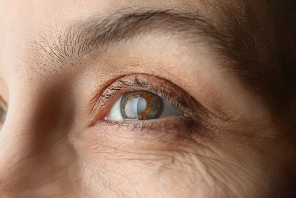 Cataract Surgery Package
