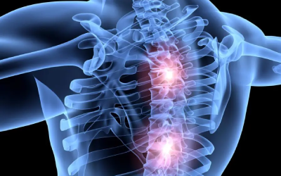 DEXA