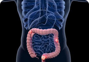 Intestinal and Colon Diseases