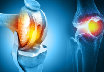 Joint-Replacement