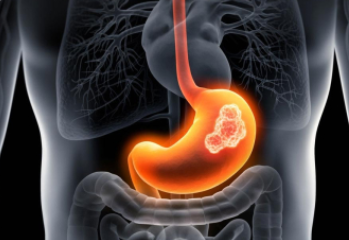 Stomach Diseases